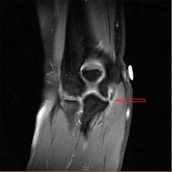 MRI Right Elbow With Contrast